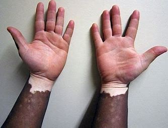 A vitiligó - Így élhet együtt a rejtélyes bőrbetegséggel