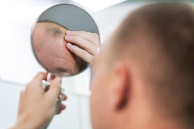 Alopecia, avagy hirtelen induló foltos hajhullás - Okok és megoldások