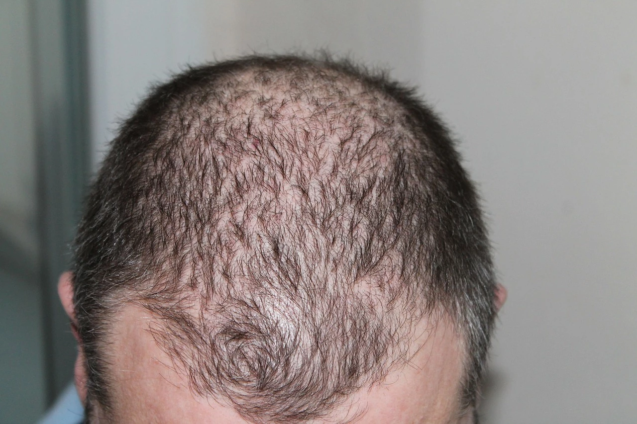 hairloss